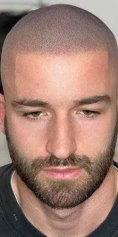 After — restored density with scalp micropigmentation