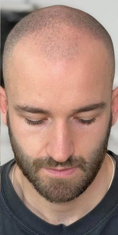 Before — thinning scalp